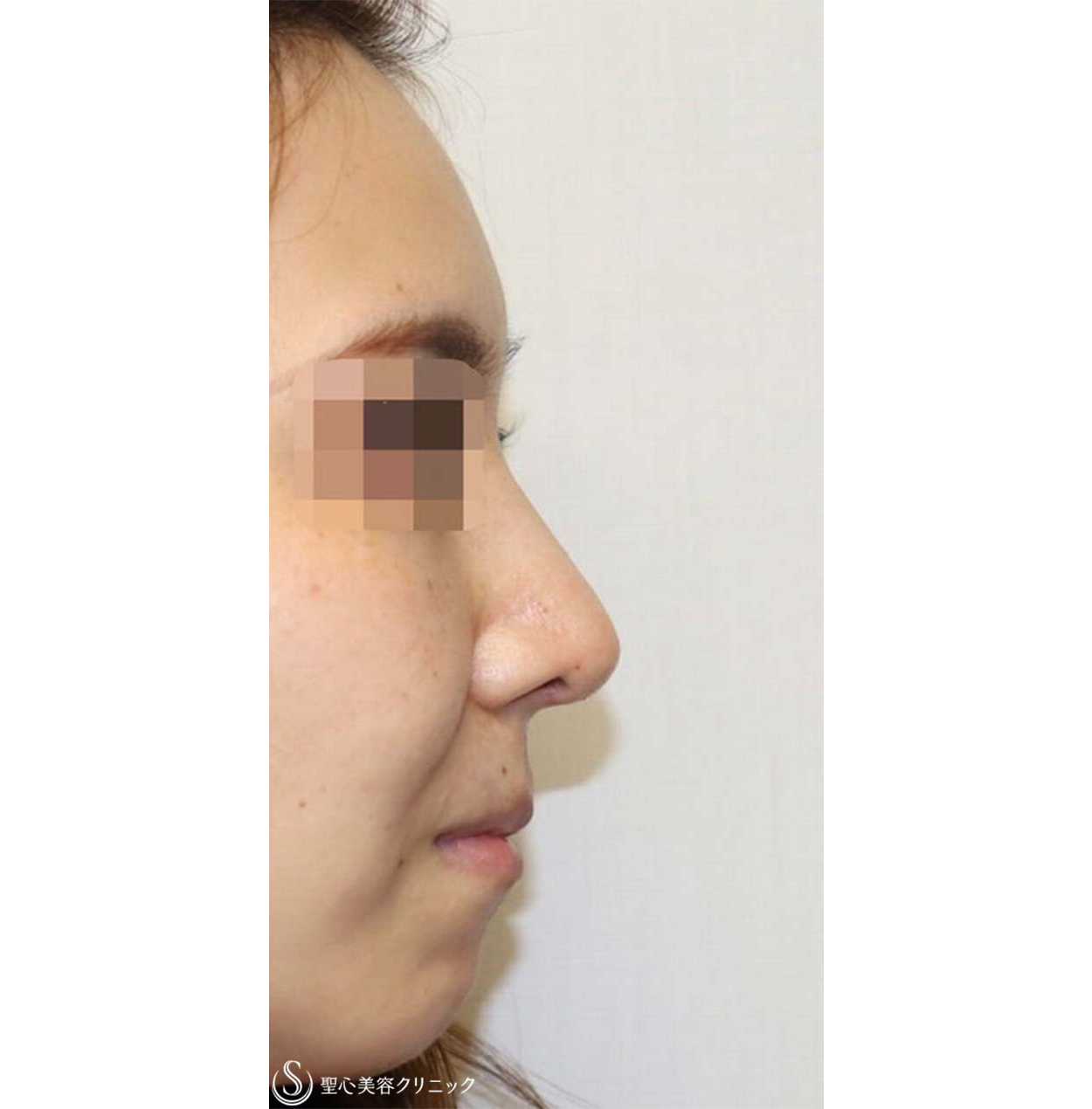 鼻中隔延長・鼻尖形成術・鼻背軟骨移植
