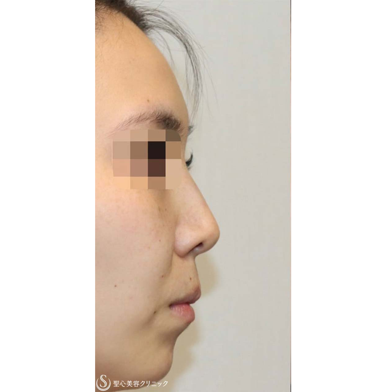 鼻中隔延長・鼻尖形成術・鼻背軟骨移植